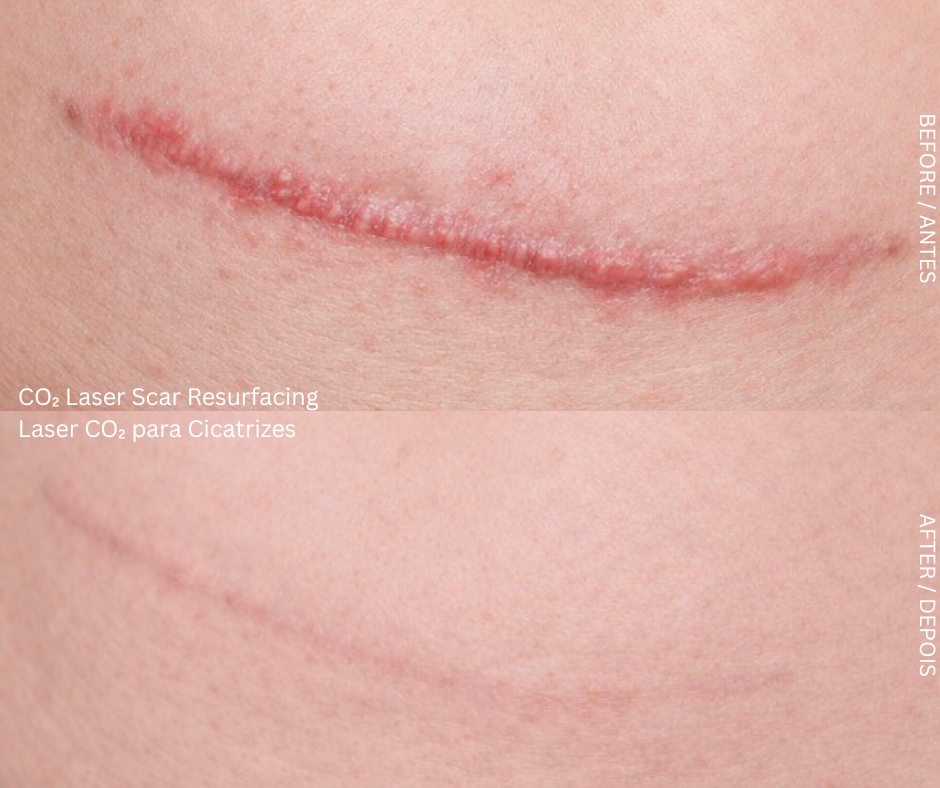 CO₂ Pixel Laser laser treatment device at AD Lisbon